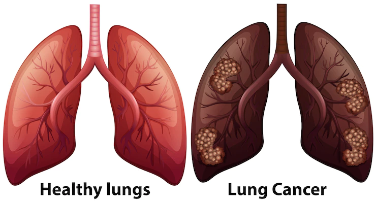 What is Lung Cancer