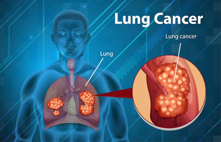 What is Lung Cancer