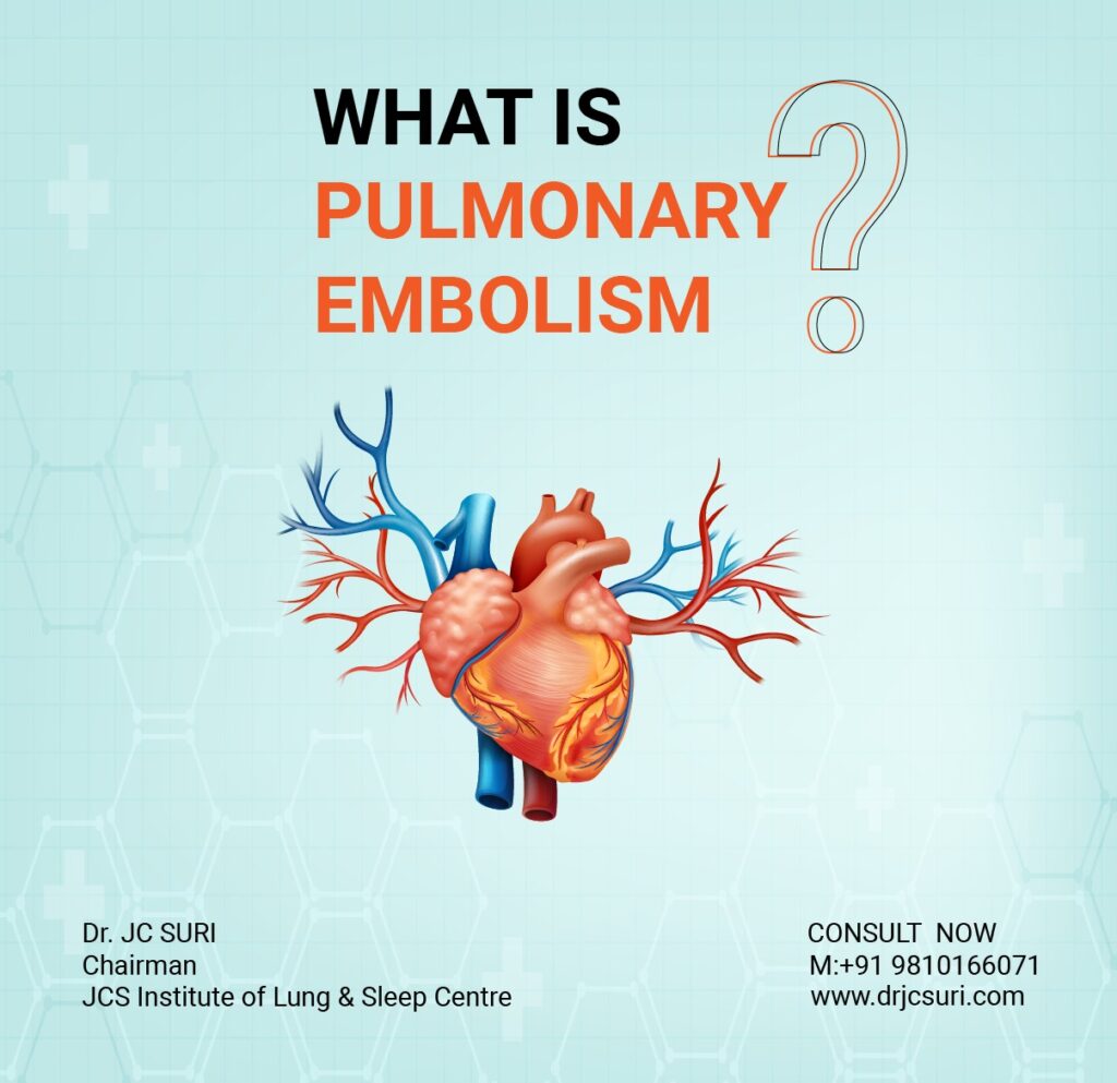 Pulmonary Embolism Explained Causes, Symptoms, and Treatment