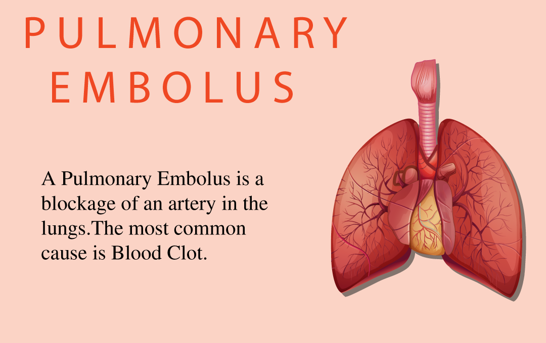 what is Pulmonary embolism