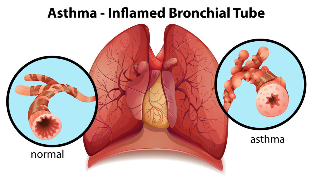 The Ultimate Guide to Finding the Best Asthma Doctor in Delhi