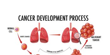 Lung Cancer: Symptoms, Types & Treatments