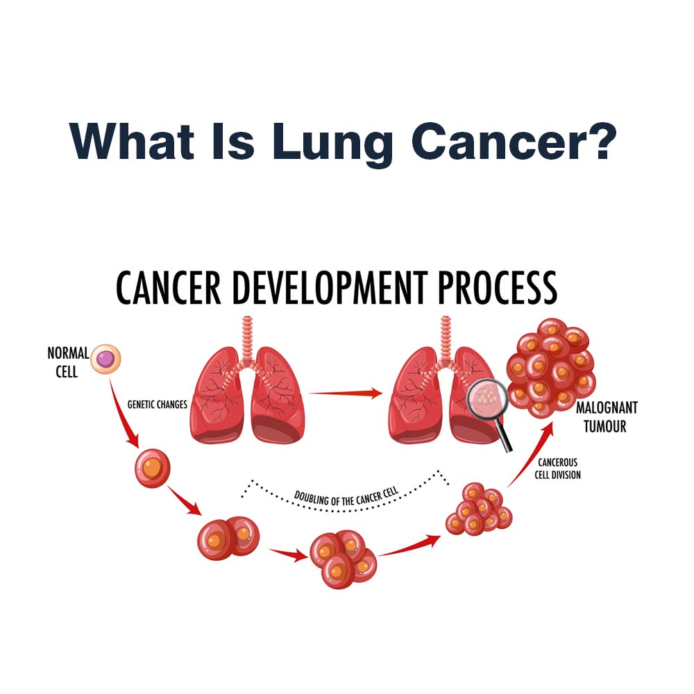 Lung Cancer